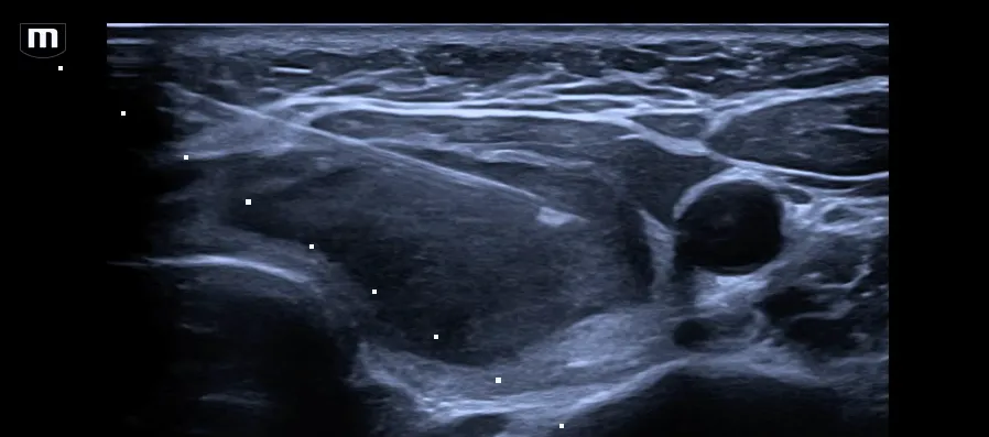 Biopsia con aguja fina por ultrasonido