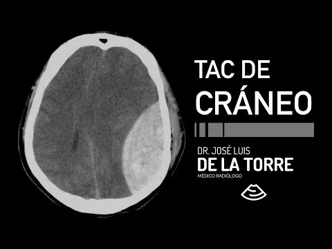 Video: ¿Cómo Interpretar Tomografía de Cráneo? - TUTORIAL
