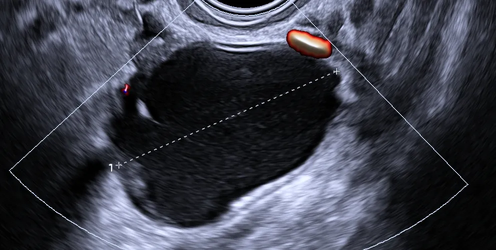 Mapeo Endometriosis