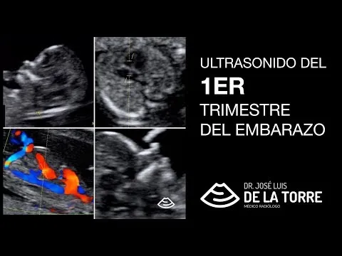 Video: ¿Qué es el ultrasonido de tamizaje del primer trimestre?