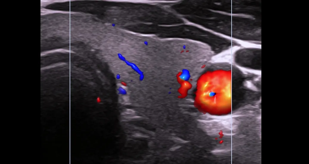Ultrasonido de cuello