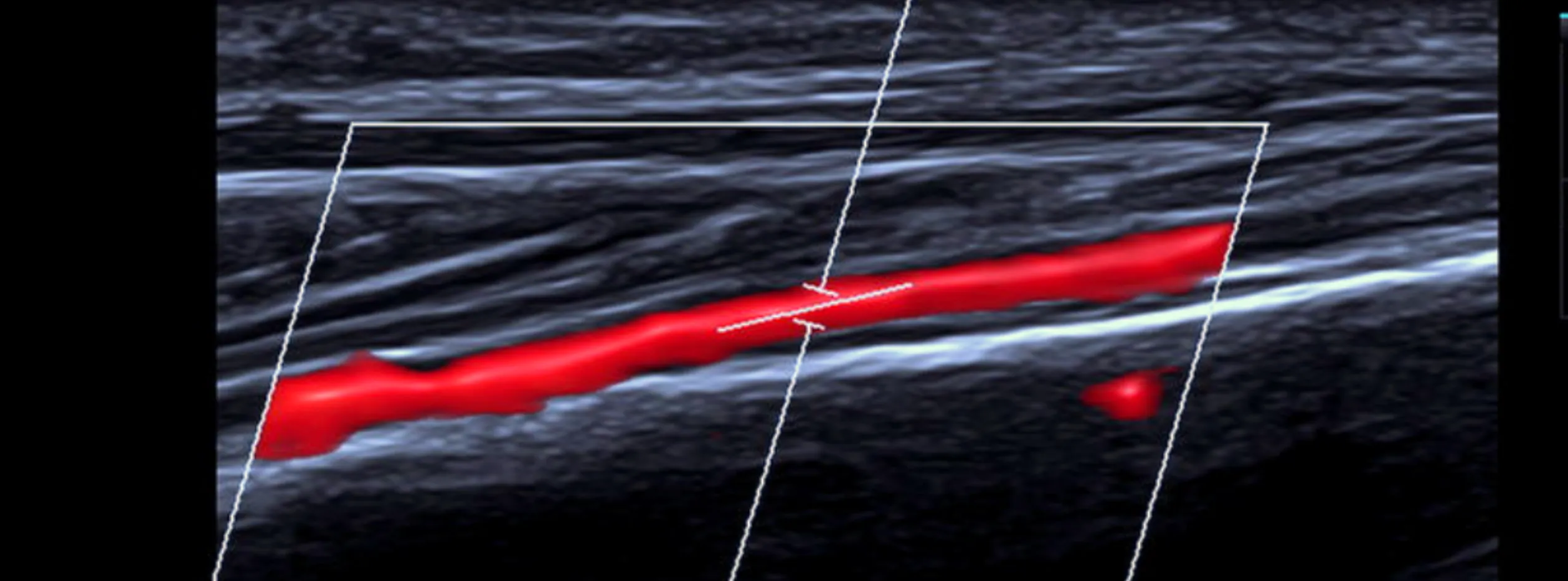 Ultrasonido Doppler arterial en extremidades
