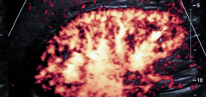 Ultrasonido Doppler de arterias viscerales (hepático, renal, mesentéricas, aorta, etc)