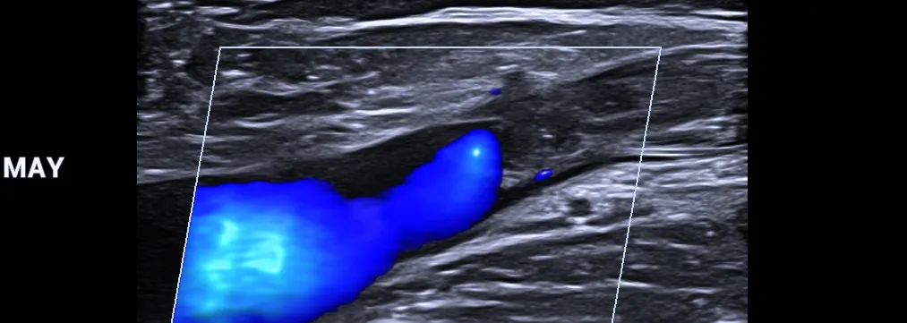 Ultrasonido Doppler venoso en extremidades