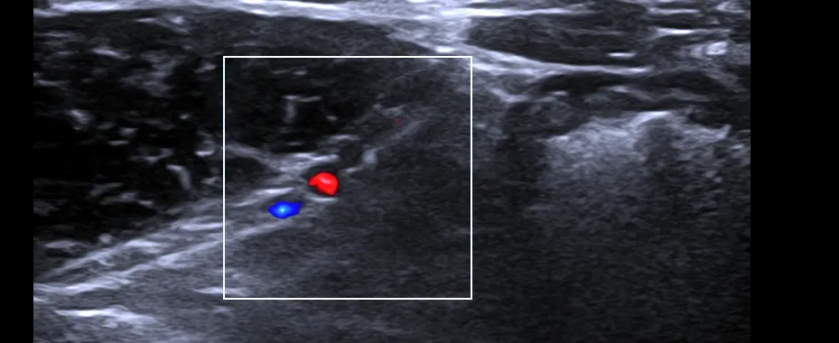 Ultrasonido inguinal