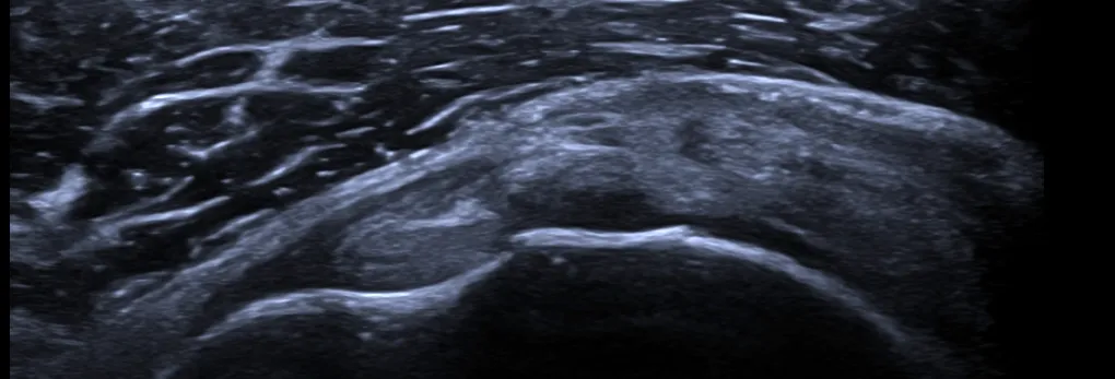 Ultrasonido muscular o tendinoso
