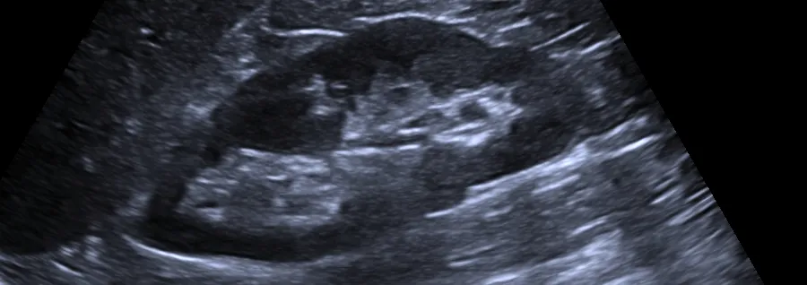 Ultrasonido renal
