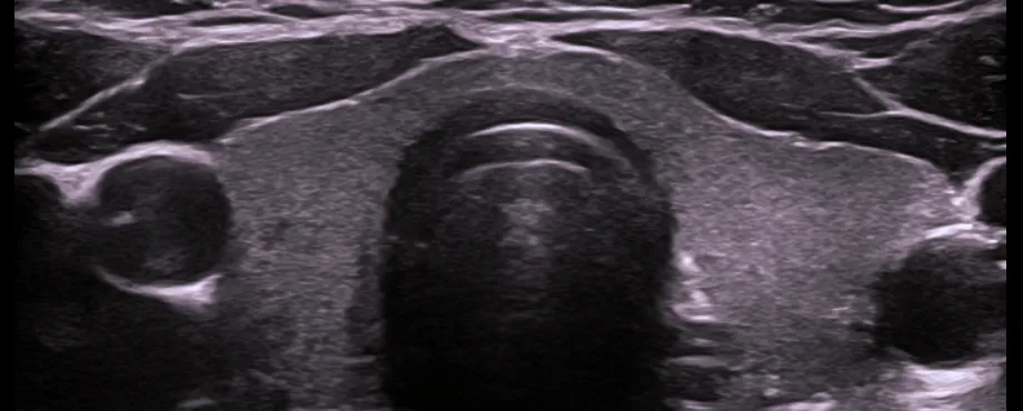 Ultrasonido tiroides