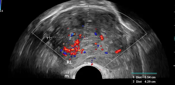 Ultrasonido transrectal